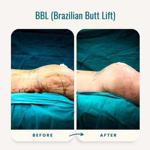 Brazilian Butt Lift Sculpting With Natural Fat IMed Medical Brazilian Butt Lift Sculpting With Natural Fat IMed Medical
