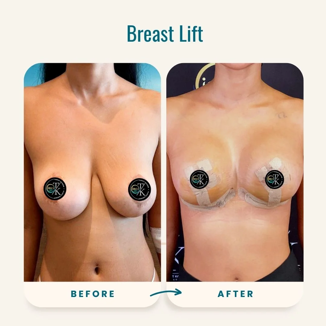 Breast Lift before-after-1 Breast Lift before-after-1