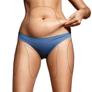 Liposuction