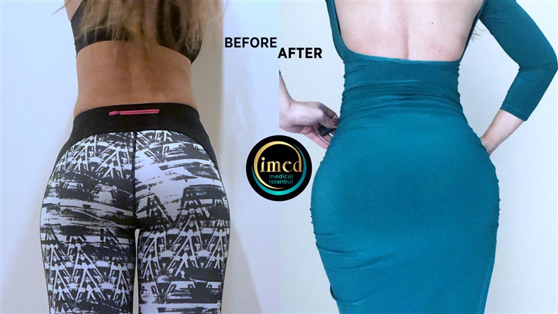 Braziliaanse Billift (Veilige BBL) - iMed Medical
