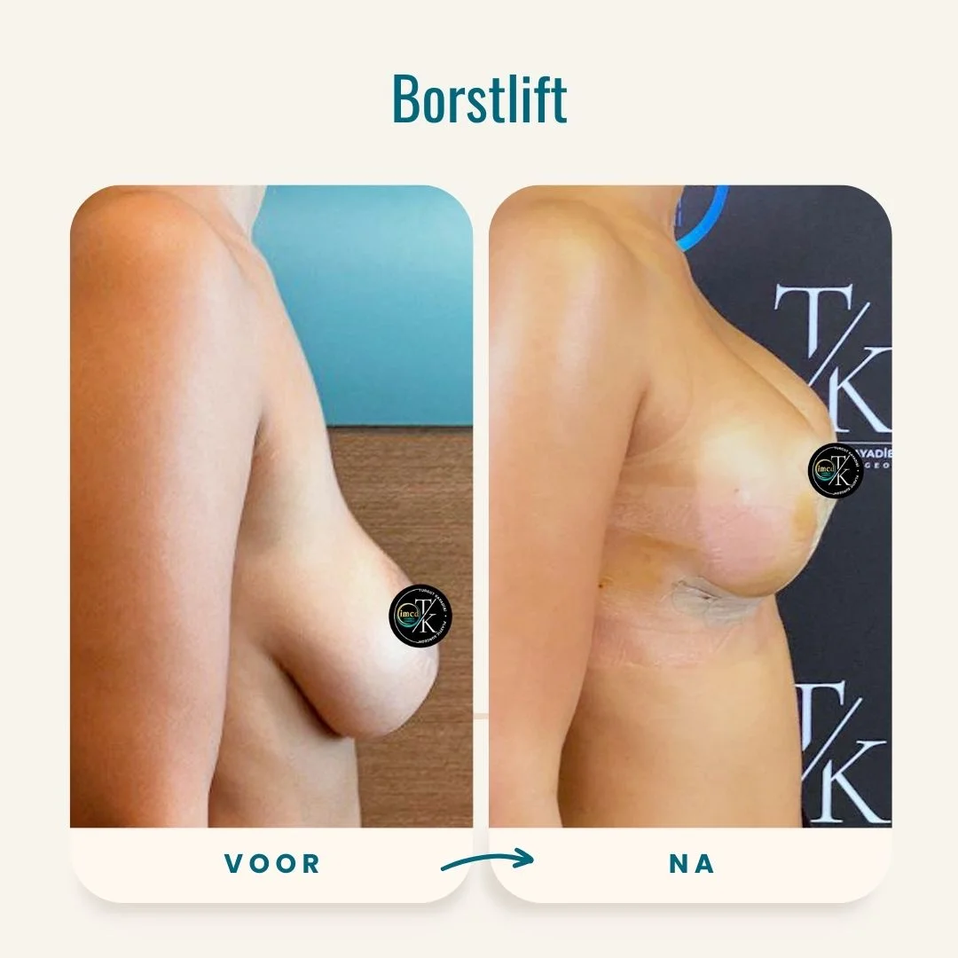 Borstlift voor-na foto's-2 Borstlift voor-na foto's-2