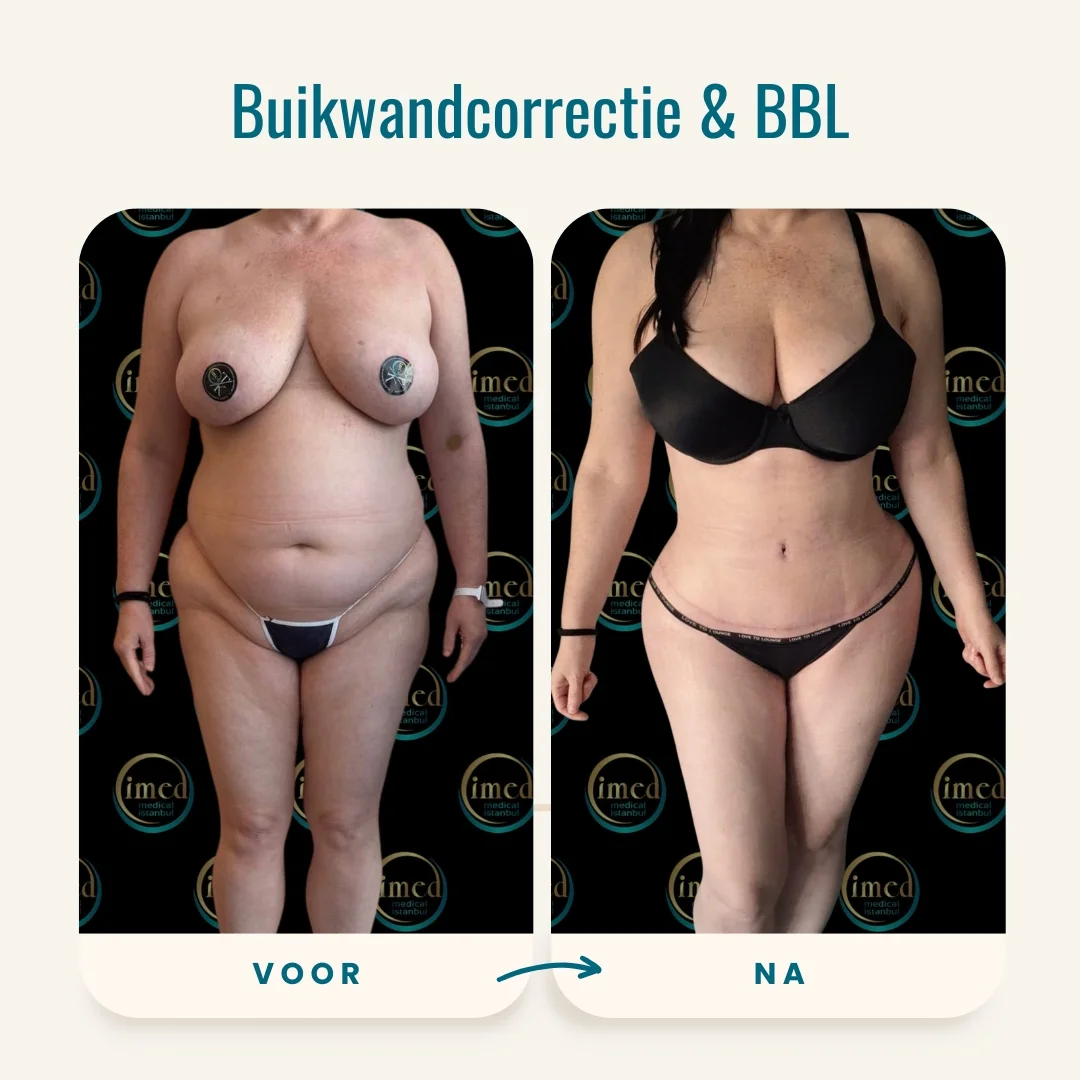 Buikwandcorrectie + BBL voor-na foto-1 Buikwandcorrectie + BBL voor-na foto-1