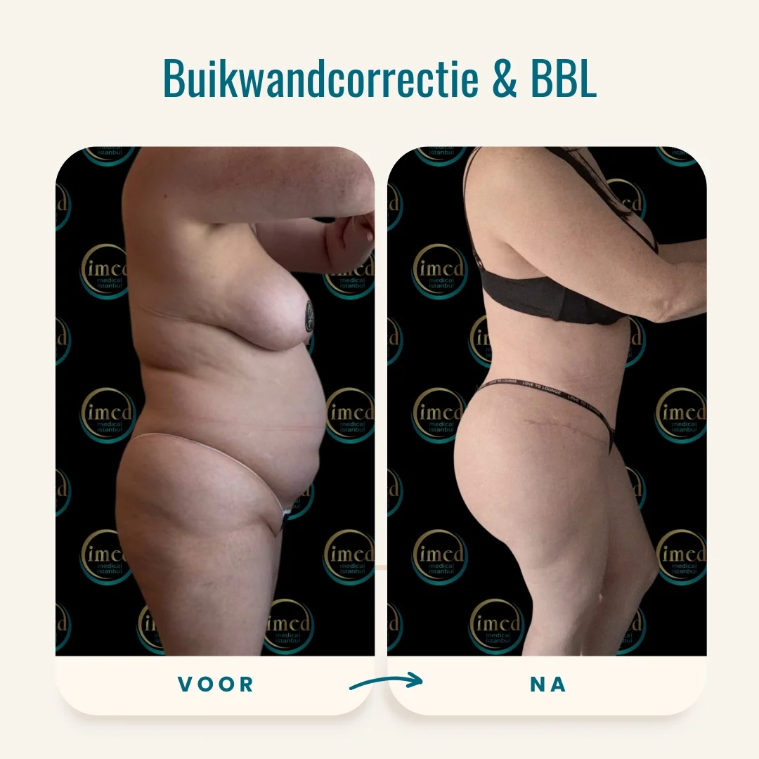 Buikwandcorrectie + BBL voor-na foto-2 Buikwandcorrectie + BBL voor-na foto-2