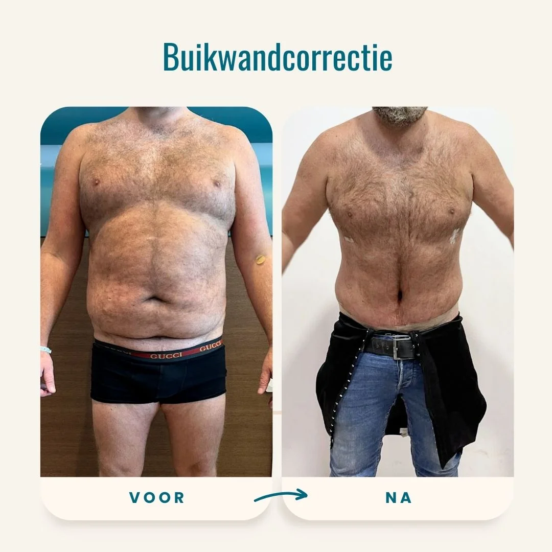 Buikwandcorrectie voor-na foto's-3 Buikwandcorrectie voor-na foto's-3