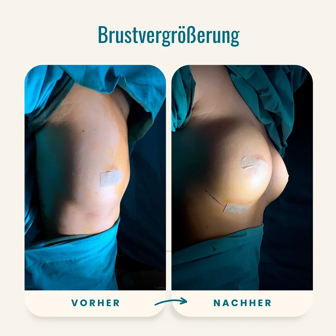 Vorher-nachher-Fotos der Brustvergrößerung-1 Vorher-nachher-Fotos der Brustvergrößerung-1