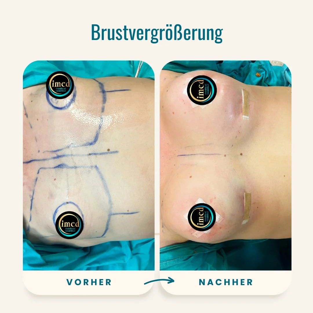 Vorher-nachher-Fotos der Brustvergrößerung-2 Vorher-nachher-Fotos der Brustvergrößerung-2