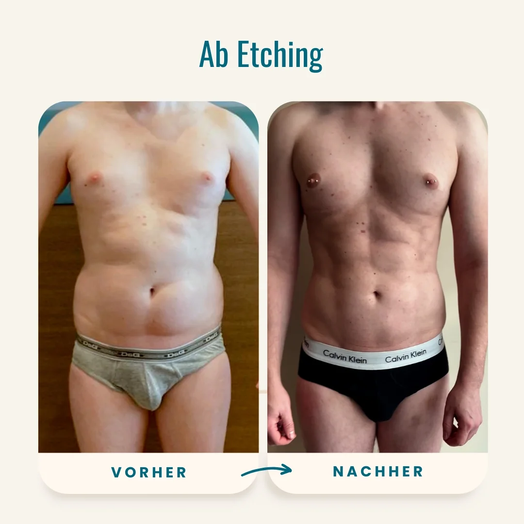 Vorher-nachher-Fotos des Ab Etching-1 Vorher-nachher-Fotos des Ab Etching-1