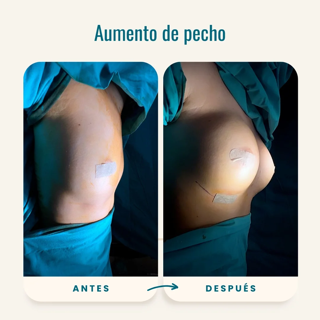 Fotos de antes y después de aumento de pecho-1 Fotos de antes y después de aumento de pecho-1