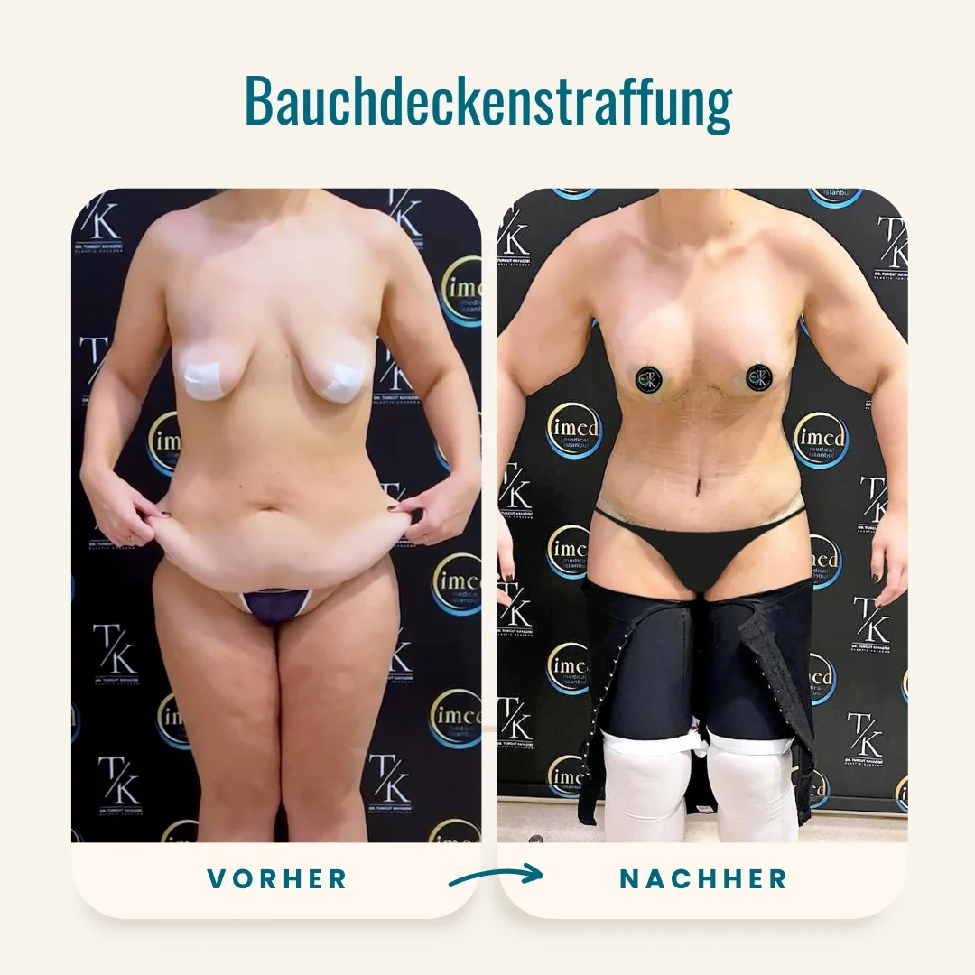 Vorher-nachher-Fotos der Bauchdeckenstraffung-1 Vorher-nachher-Fotos der Bauchdeckenstraffung-1