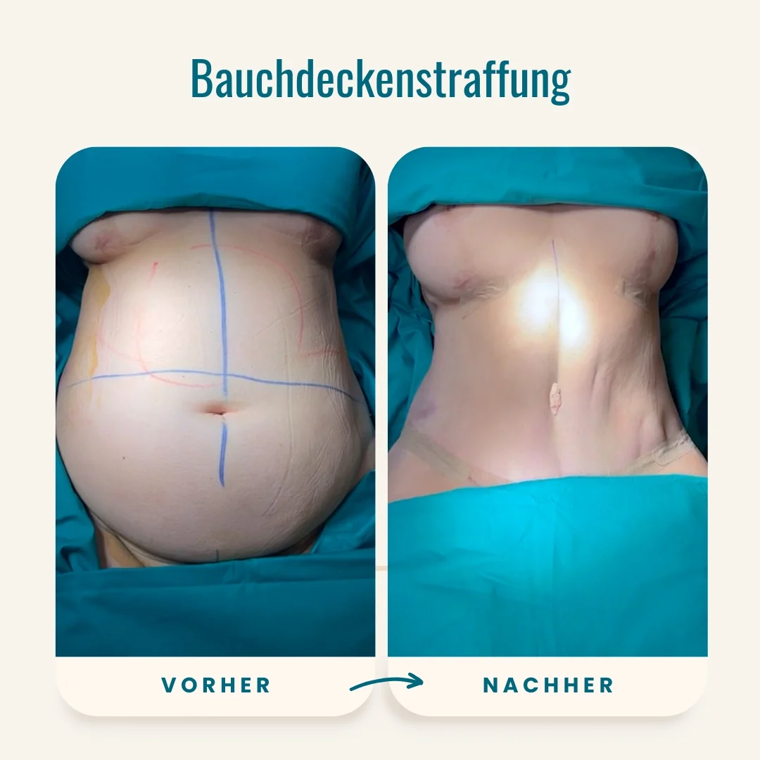 Vorher-nachher-Fotos der Bauchdeckenstraffung-2 Vorher-nachher-Fotos der Bauchdeckenstraffung-2