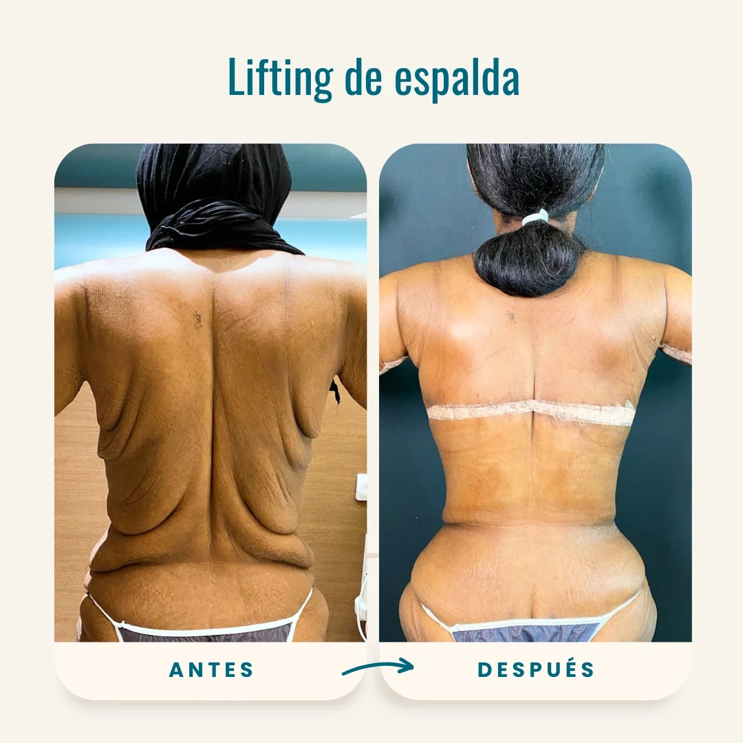 Fotos de antes y después de lifting de espalda-1 Fotos de antes y después de lifting de espalda-1