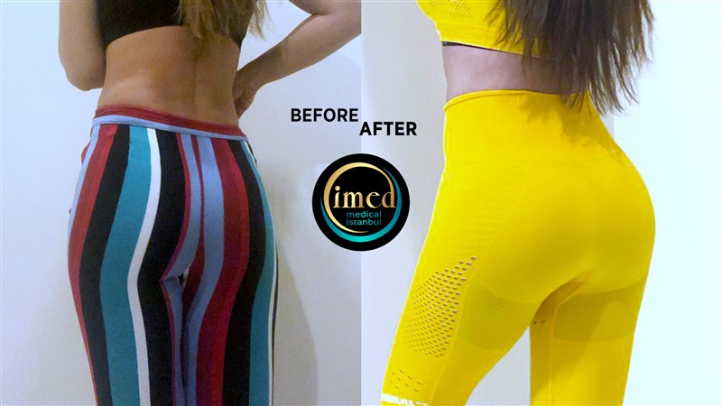 Brazilian Butt Lift Safe BBL IMed Medical
