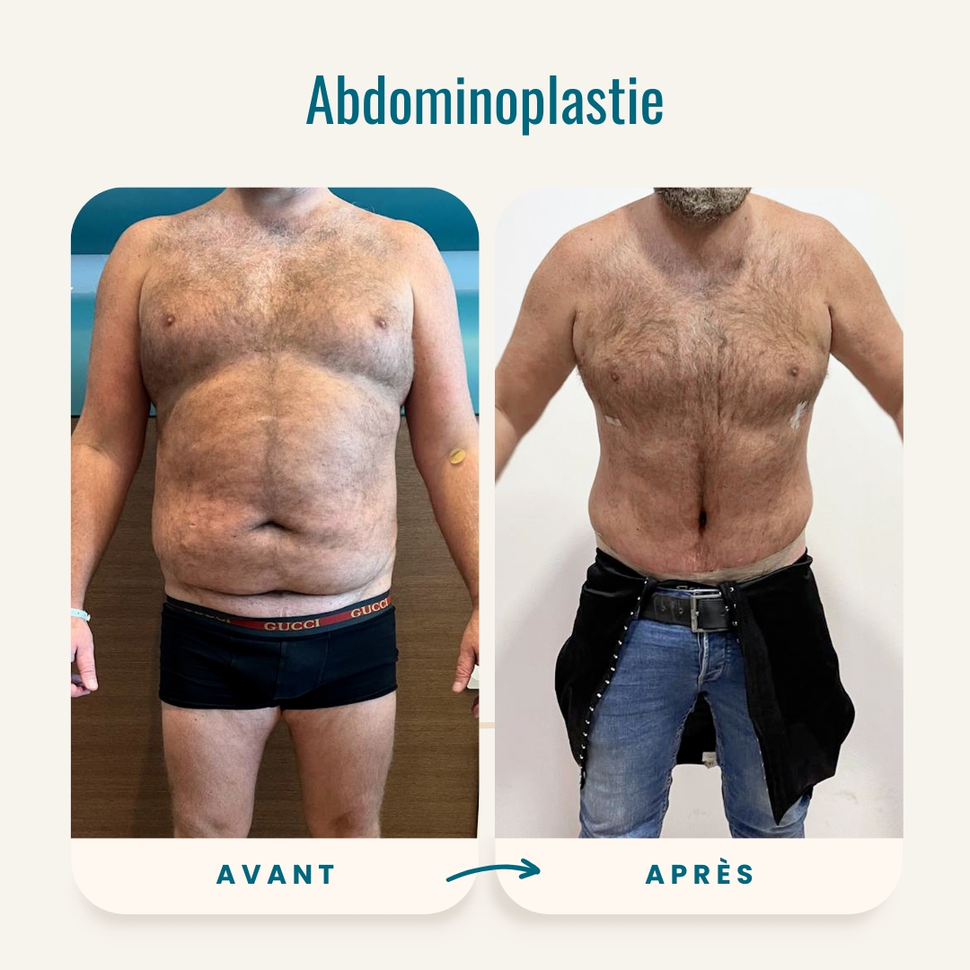 Photos de l'abdominoplastie avant et après-3 Photos de l'abdominoplastie avant et après-3