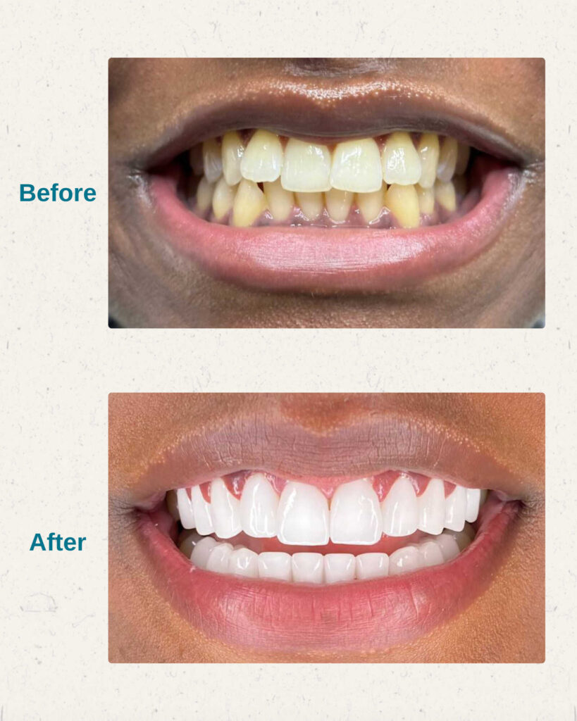hollywood smile before after