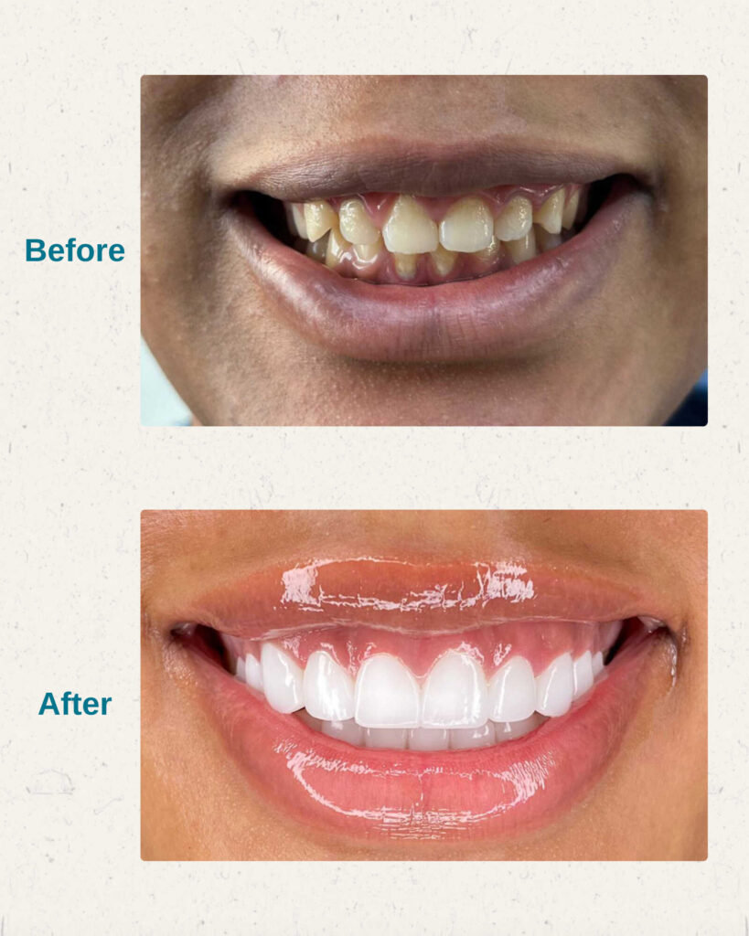 hollywood smile before after