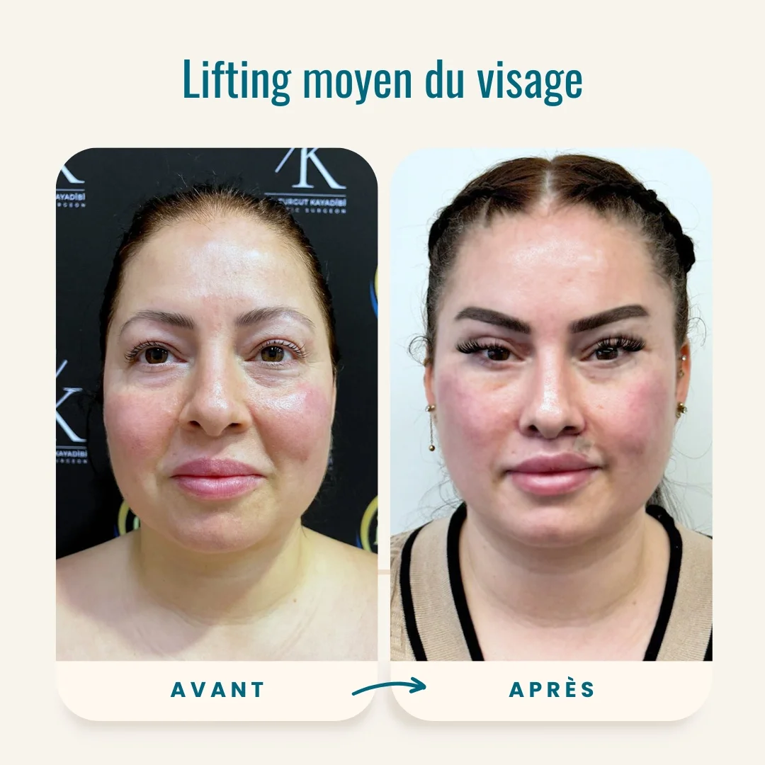 Photos avant-après du lifting moyen du visage-1 Photos avant-après du lifting moyen du visage-1