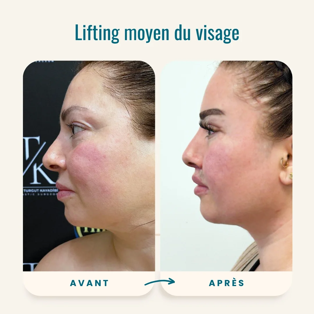 Photos avant-après du lifting moyen du visage-3 Photos avant-après du lifting moyen du visage-3