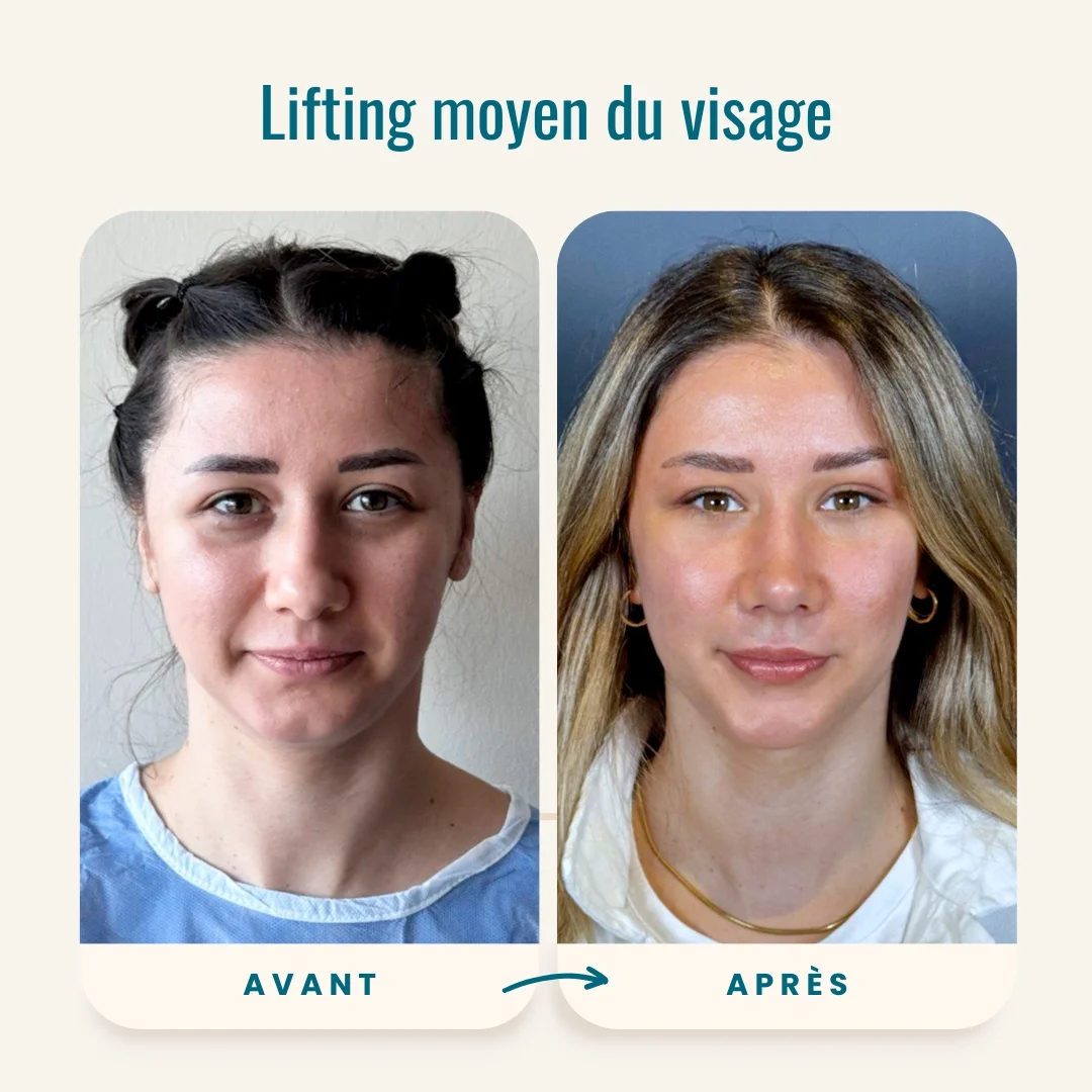 Photos avant-après du lifting moyen du visage-4 Photos avant-après du lifting moyen du visage-4