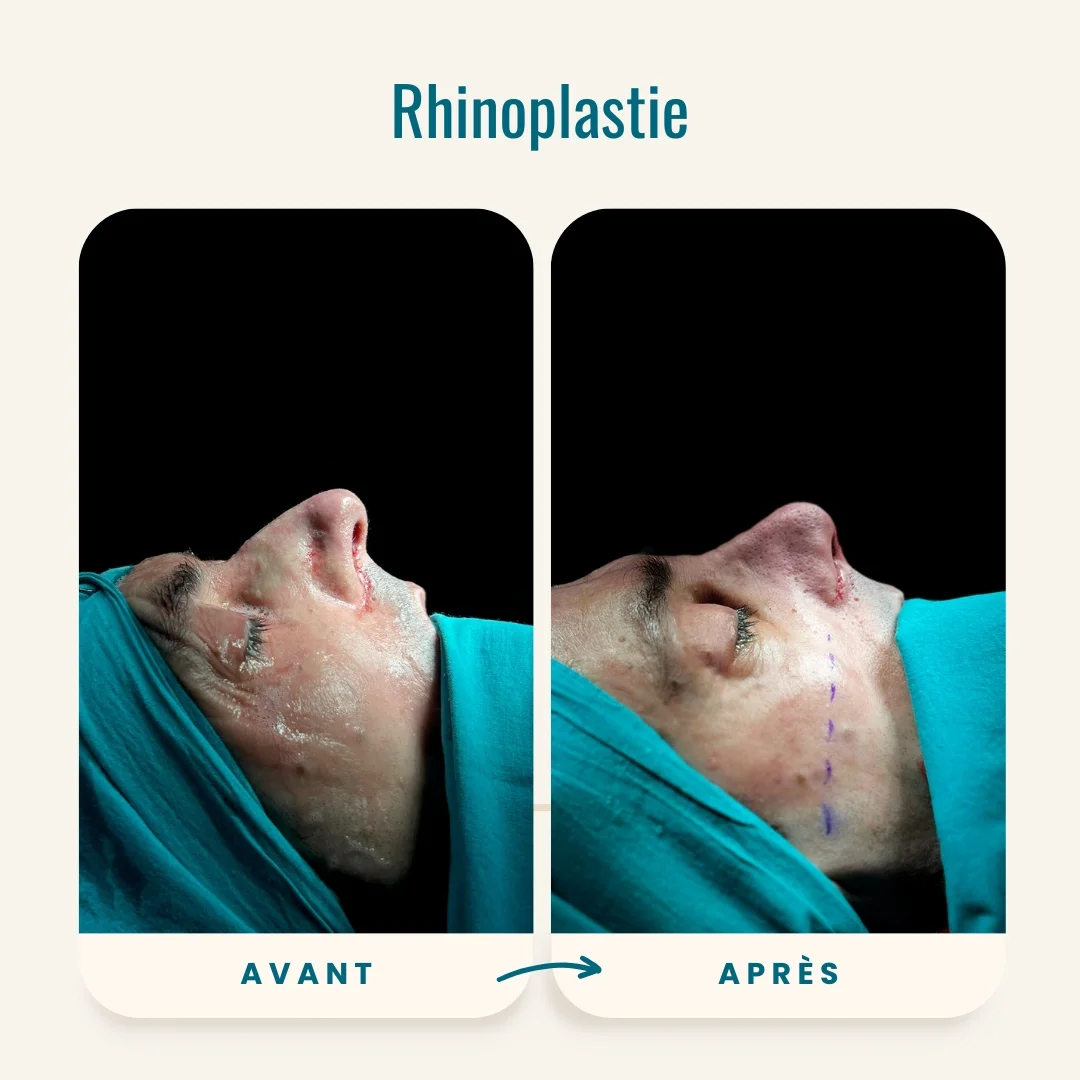 Photos avant-après de la rhinoplastie-3 Photos avant-après de la rhinoplastie-3