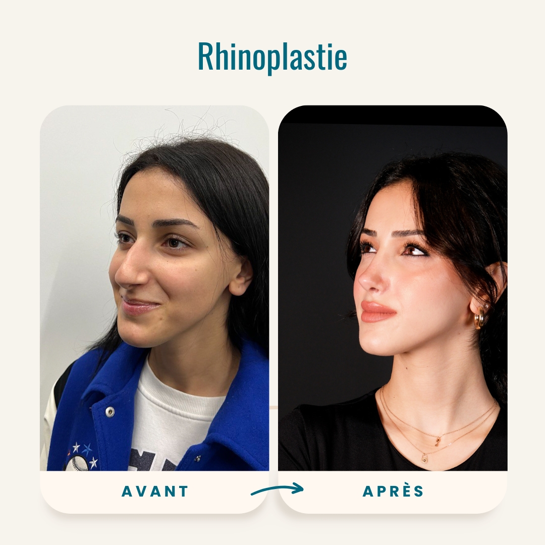 Photos avant-après de la rhinoplastie-4 Photos avant-après de la rhinoplastie-4