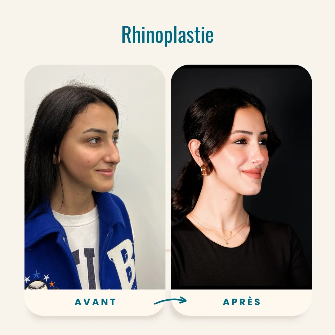Photos avant-après de la rhinoplastie-5 Photos avant-après de la rhinoplastie-5