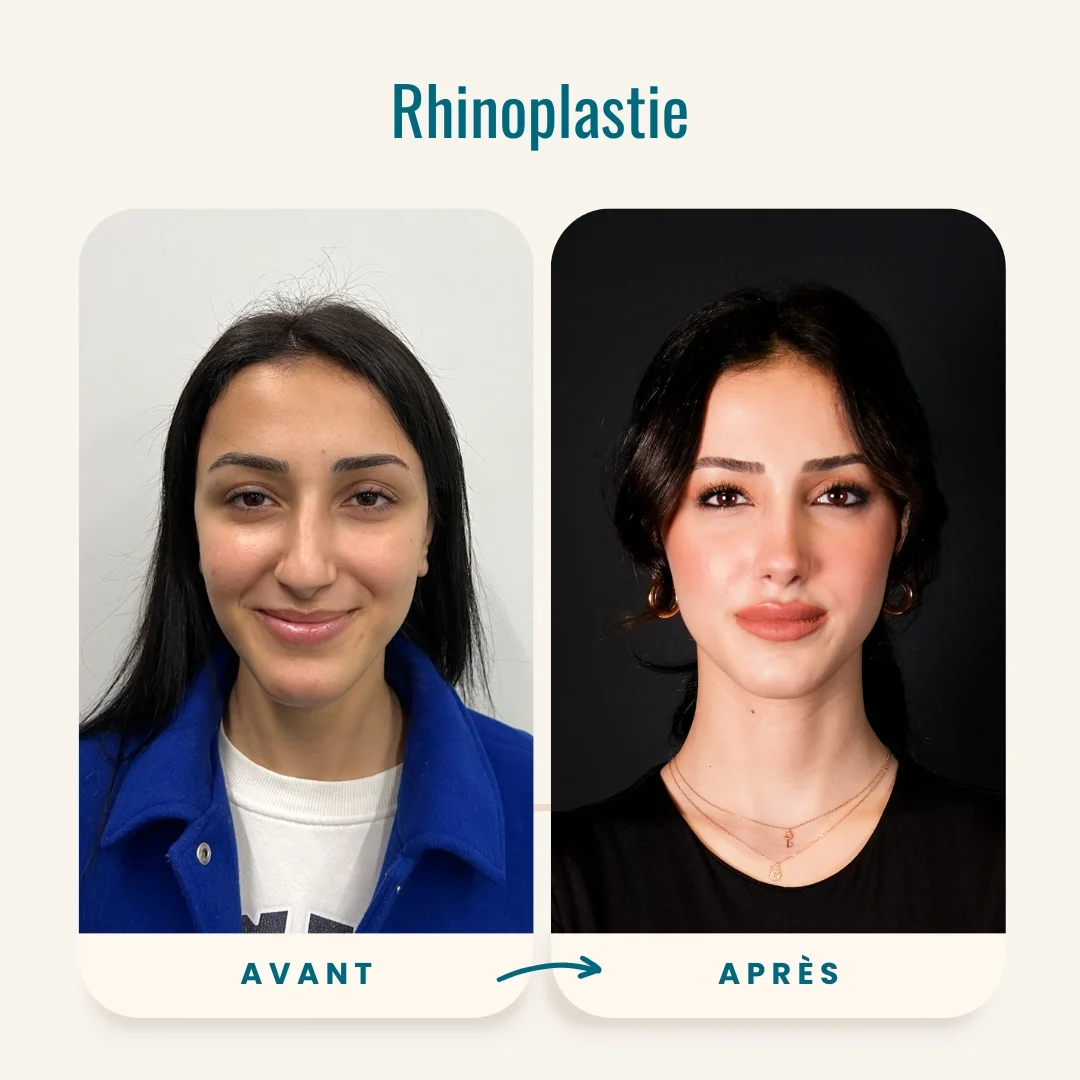 Photos avant-après de la rhinoplastie-6 Photos avant-après de la rhinoplastie-6