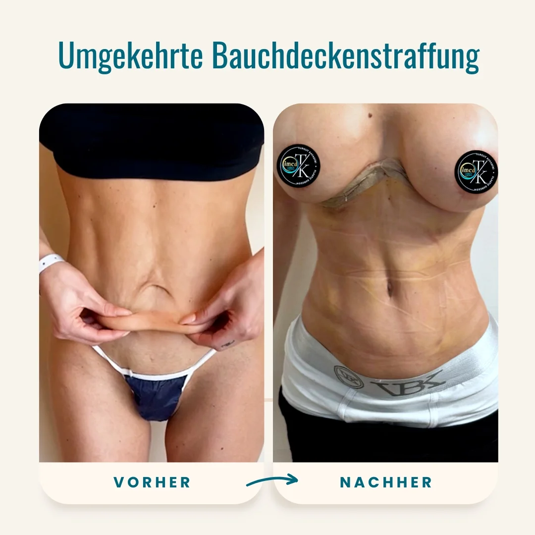 Vorher-nachher-Fotos der umgekehrten Bauchdeckenstraffung-1 Vorher-nachher-Fotos der umgekehrten Bauchdeckenstraffung-1