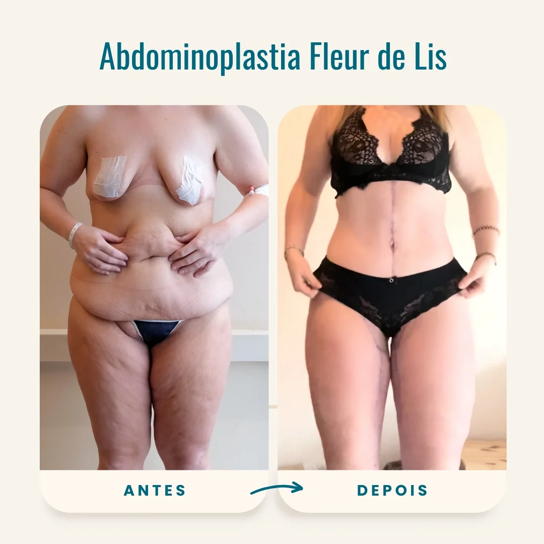 Fotos de antes e depois da abdominoplastia fleur de lis-1 Fotos de antes e depois da abdominoplastia fleur de lis-1