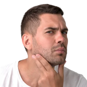 beard transplantation