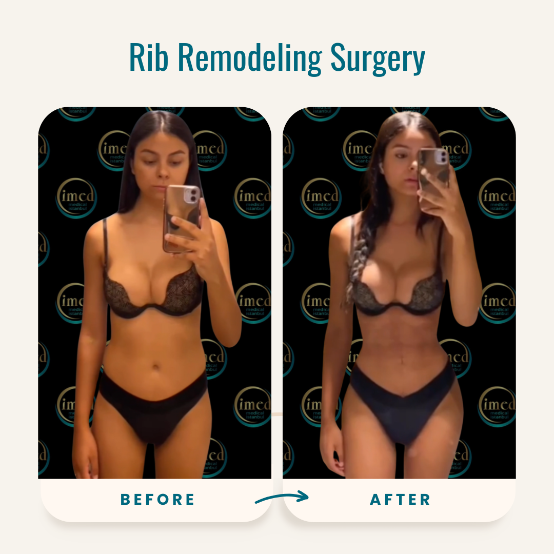 Rib Remodeling Surgery Before-After Img-1 Rib Remodeling Surgery Before-After Img-1