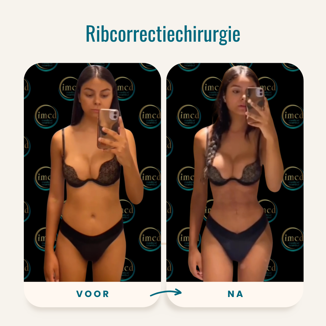 Ribcorrectiechirurgie Voor Na Resultaten Taille Contouring ribcorrectiechirurgie voor na taille contouring slankere taille resultaat vrouw