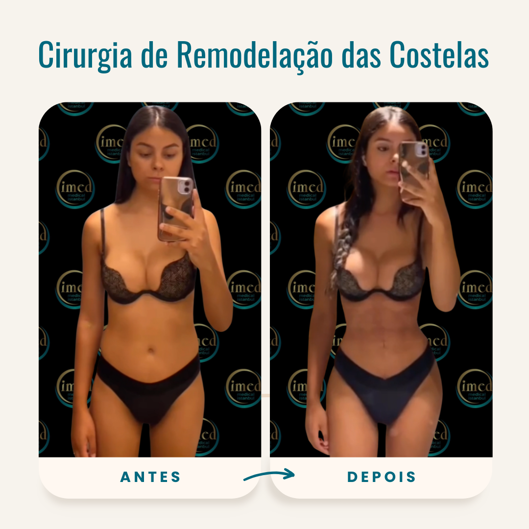 Cirurgia remodelação das costelas antes depois Antes e depois cirurgia remodelação das costelas
