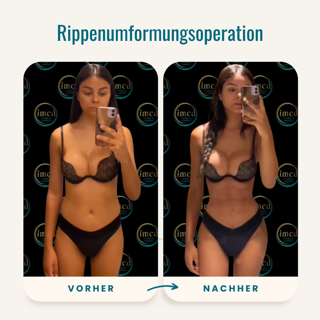 Rippenumformungsoperation Vorher Nachher Vorher Nachher Rippenumformungsoperation